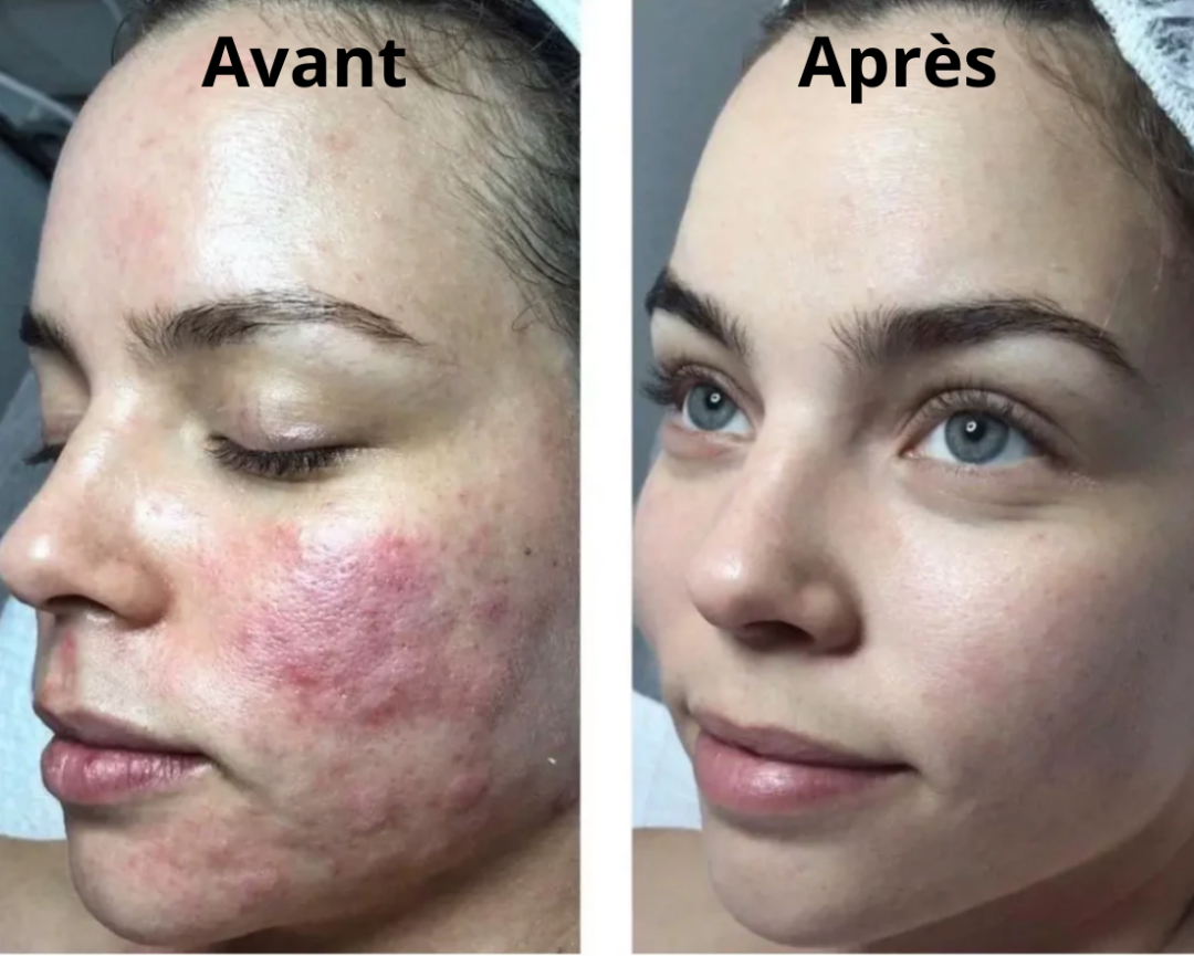 Stylo Microneedling -75%